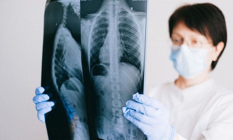 Explican expertos qué es un nódulo pulmonar y cómo se diagnostica